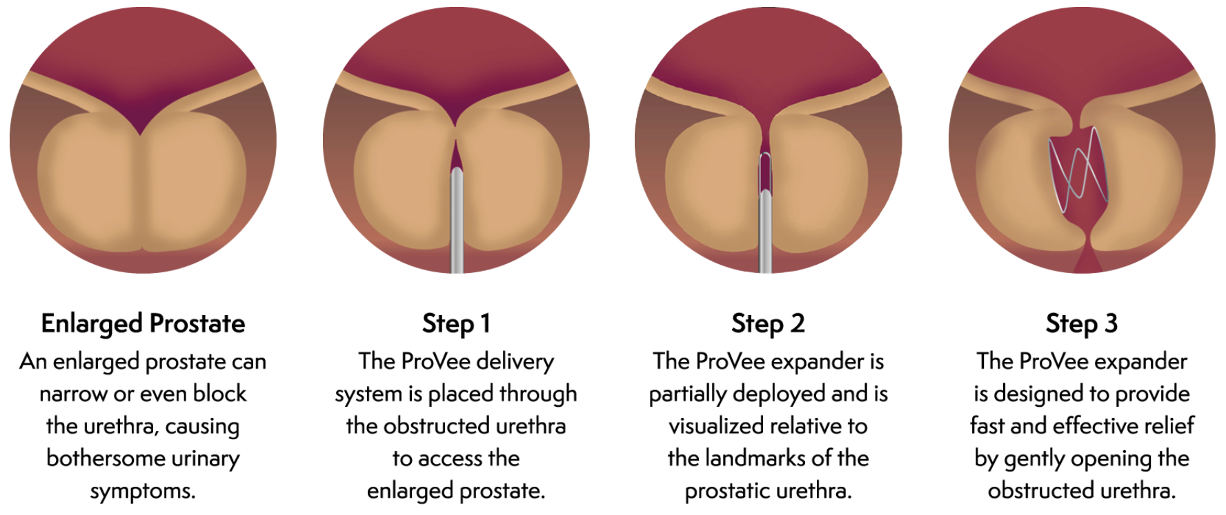 an illustration, in four images, showing how the ProVee delivery system inserts ProVerum's device into the enlarged prostate where the expander provides relief by gently opening the obstructed urethra